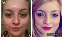 Zoretanin ve Roaccutane Arasında Fark Var Mı?