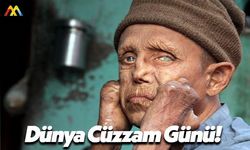 Dünya Cüzzam Günü!